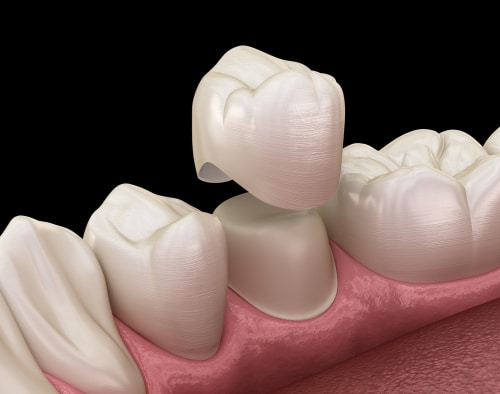 A graphic image of a dental crown being placed in Grove City.