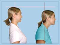 Forward head posture