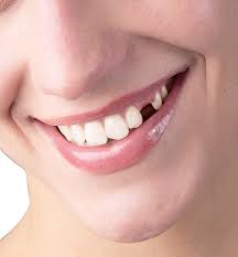Smile With Missing Tooth