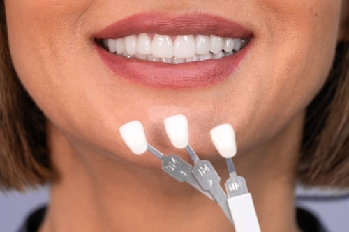 Porcelain veneers samples in Grove City.