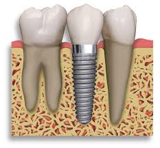 Dental Implant Rendering.