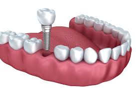 A detailed dental implant rendering.