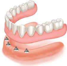 Dental Implant Photo