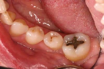 Before cavity