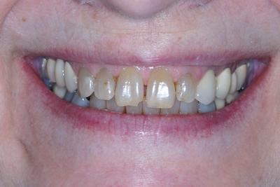 Patient with unsightly teeth before receiving cosmetic dental care in Grove City