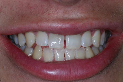 Before invisalign