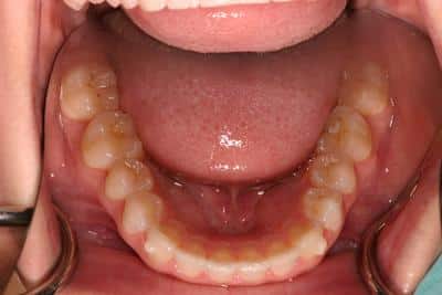 Grove City Dentist After Picture 2