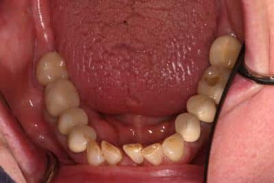 Before Dental Work