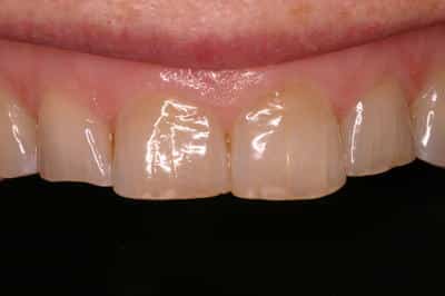 Before whitening