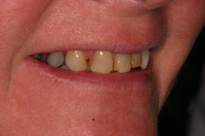 Before full mouth rehabilitation in Grove City