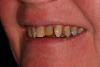 Before teeth