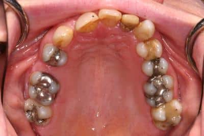 Before teeth