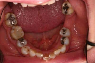 Before dental work