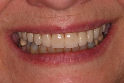 Patient smiles after dental veneers and crowns treatment in Grove City