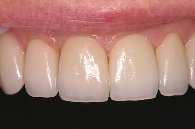 After whitening
