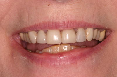 Before whitening