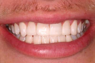 Real patient with straight white teeth after Invisalign treatment in Grove City