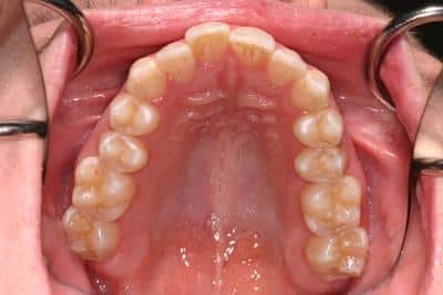 Before Crooked Teeth