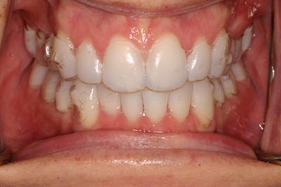 After Dental Work