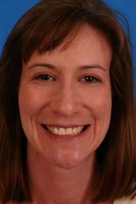before yellow teeth treatment in Grove City