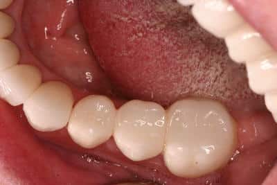after teeth whitening