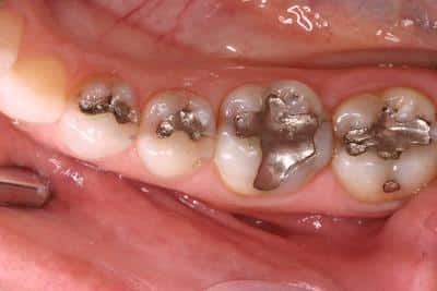 Before dental onlays in Grove City