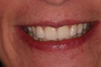 After teeth whitening