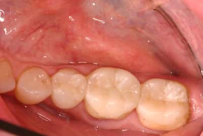 Clean white teeth after porcelain onlays in Grove City