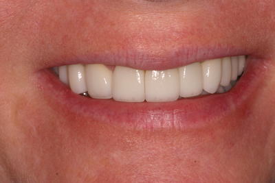 After teeth