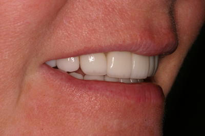 After full mouth rehabilitation treatment in Grove City