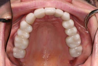 After dental work