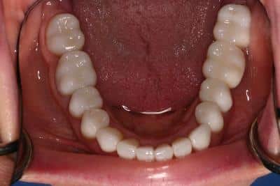 After dental work