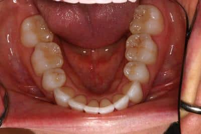 After Invisalign photos