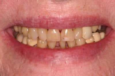 After Dental Work