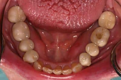 After Dental Work
