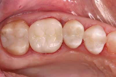 Patient after photo from replacing old fillings at Grove city dentist