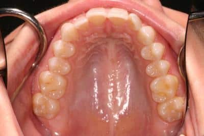 Grove City Dentist Before Picture 1