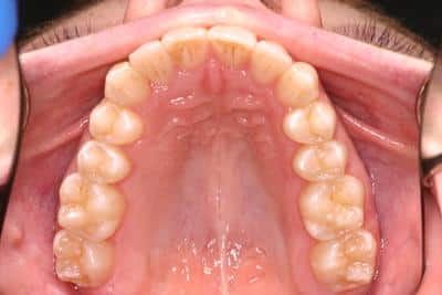 After crooked tooth