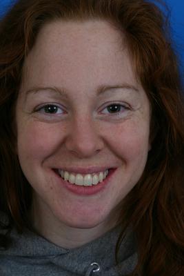 Before crooked teeth treatment in Grove City