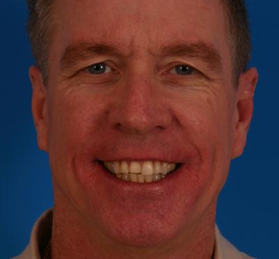 Before Whitening treatment in Grove City