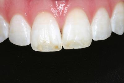 Grove City Dentist Before brown stain removal
