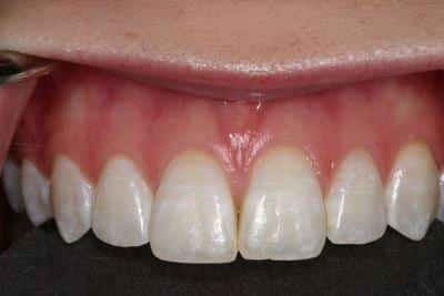 Grove City Dentist after brown stain removal photo