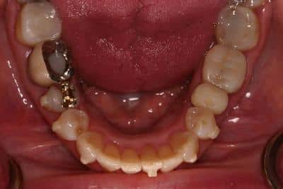 After Dental Work