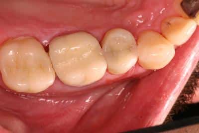 After cosmetic dental treatment in Grove City