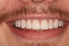 veneers after