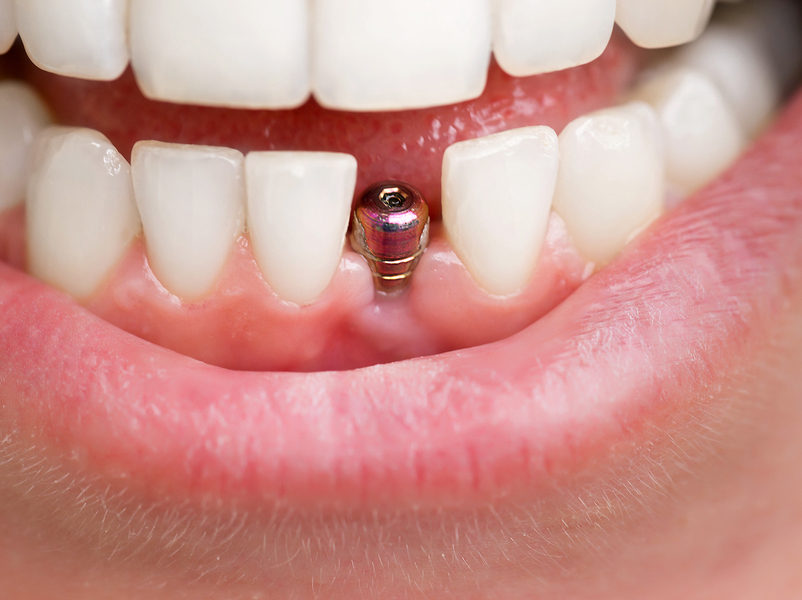 Close-up of a dental implant post in a person's upper jaw with surrounding teeth.