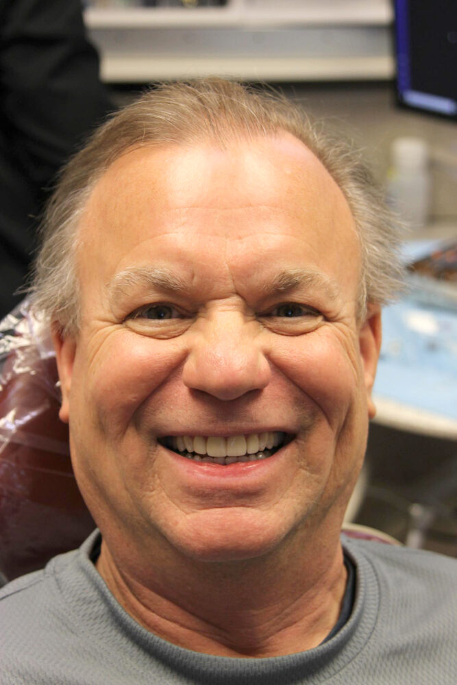 Real patient after Invisalign photo