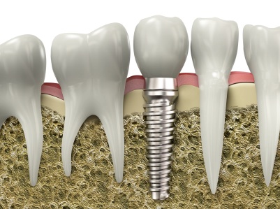 A graphic image of a dental implant placed in a jawbone by a Grove City dentist.
