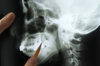 An X-ray of a jawbone being examined by a Grove City area emergency dentist.